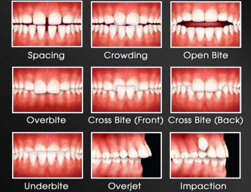 When To Get An Orthodontic Consult