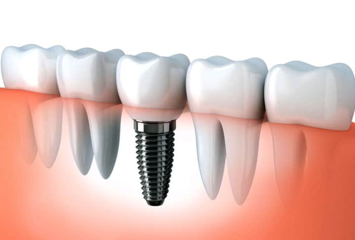 how long do dental implants last